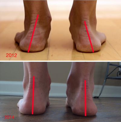 «Good» running shoes lead to injuries – here is the proof: